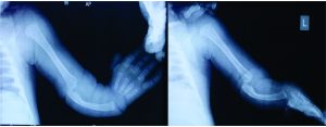 Figure 2: Radiograph of Type 4 club hand showing complete absence of radius with bowing of ulna and rudimentary thumb