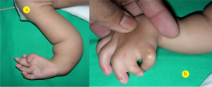 Figure 3 a & b: Clinical picture of child with fetal valproate syndrome showing syndactyly of 2nd web space and hypoplastic thumb and index finger