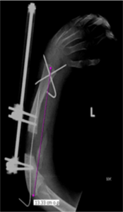 Figure 11: Ulnar lengthening using external fixator