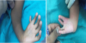 Figure 5: Variable degrees of thumb deficiencies
