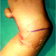 Figure 6: Transverse ulnar incision for centralization 