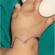 Figure 8: Dorsal bilobed skin incision as described by Evans