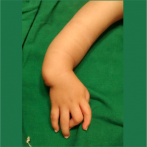 Figure 1 b: dorsal view of the same showing some amount of elbow hypoplasia clinically by lack of dimpling and flexion at the cubital fossa region ,extremely short forearm and a pronounced volar subluxation at the wrist due to complete absence of the radial pillar