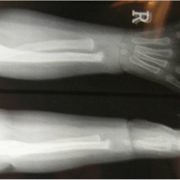 Figure 4 a: X ray of Gr 2 radial club hand.