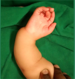 Figure 1 a: volar view of a radial club hand showing manus varus, severely bowed and shortened forearm ,mild thumb hypoplasia and symphallangic index and camptodactylous middle digits.