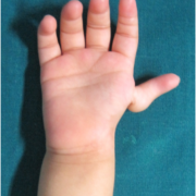 Figure 1: Preoperative picture of Type IV thumb hypoplasia (volar view)