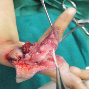 Figure 12: Extensor Indicis proprious (EIP) cut and raised off MP joint so as to act on distal interphalangeal as future extensor pollicis longus
