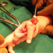 Figure 17: Index finger is fixed at CMC level