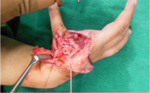 Figure 18: Suturing first dorsal interosseous to lateral band as the new abductor opponens complex