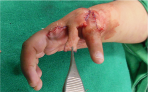 Figure 19: Adjusting skin flaps to get new thumb in opposition and pronation