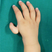 Figure 2: Preoperative picture of Type IV thumb hypoplasia (dorsal view)