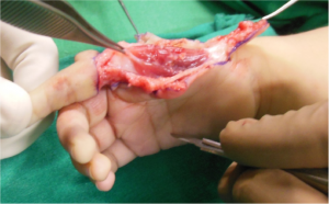Figure 8: First dorsal interroseous raised with tendon